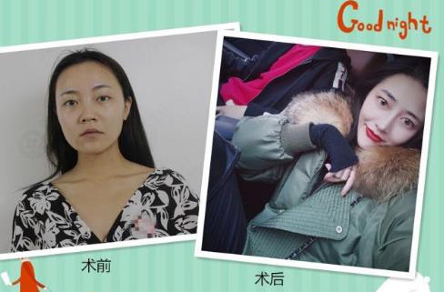 硅膠隆鼻和自體軟骨隆鼻相比較