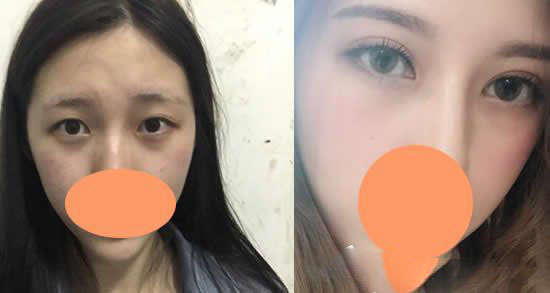 景德鎮(zhèn)圣嘉麗整形劉院長雙眼皮整形果對比圖