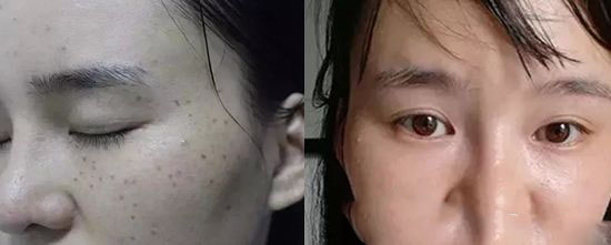 景德鎮(zhèn)圣嘉麗整形術激光祛斑一個月后：