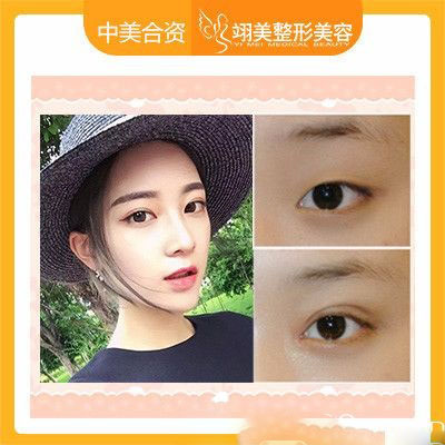 廣州翊美祖秉毅院長做的雙眼皮案例