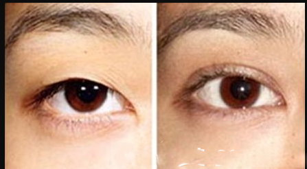 無錫曼陀羅的術(shù)前和術(shù)后比較