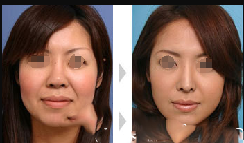 無錫曼陀羅的術(shù)前和術(shù)后比較