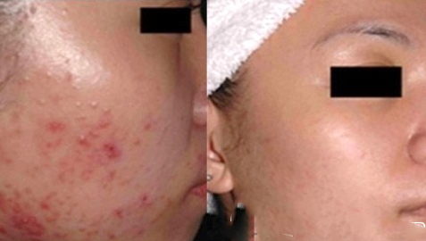 DaturaWuxi術(shù)前與術(shù)后激光祛痤瘡療比較