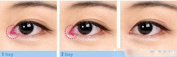 微創(chuàng)眼內(nèi)開角術(shù)