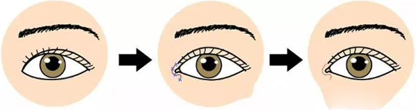 超微創(chuàng)突眼