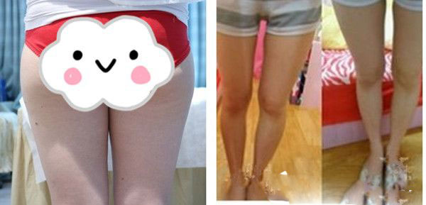 贛州儷人醫(yī)療美容診所吸脂瘦腿案例