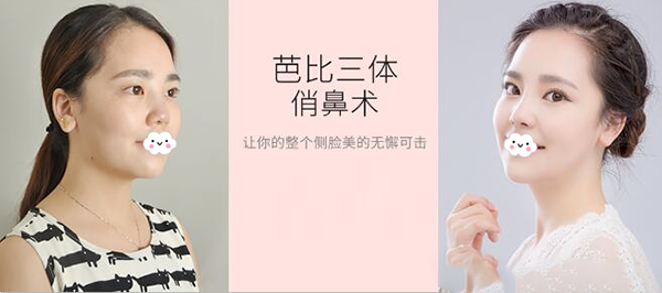 珠海愛思特隆鼻案例