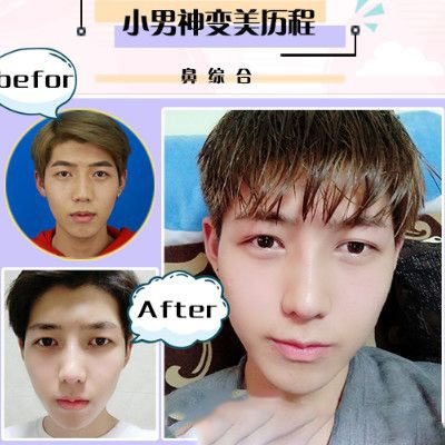 珠海愛思特李德新鼻部手術隆鼻案例