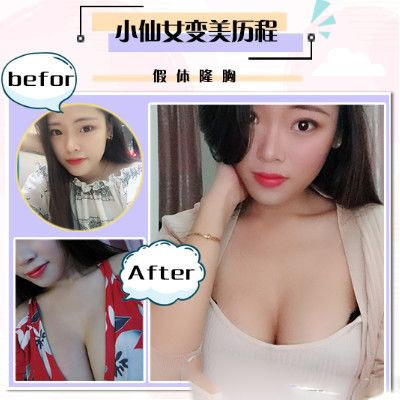 珠海愛思特李德新假體隆胸案例