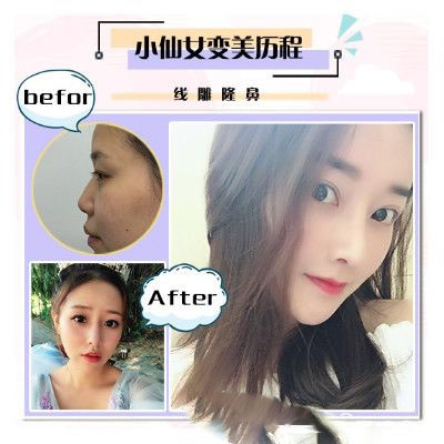 珠海愛思特隆鼻案例