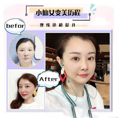 珠海愛思特面部埋線提升埋線提升案例