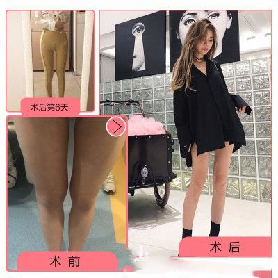 珠海愛思特大腿吸脂案例