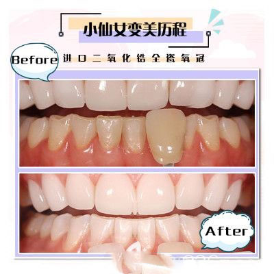 珠海愛思特全瓷牙調(diào)節(jié)案例