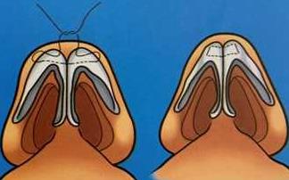 鼻頭縮小手術(shù)介紹