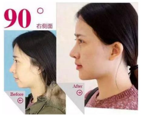 鼻頭縮小手術(shù)后的恢復(fù)