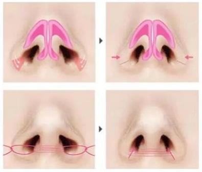 鼻翼縮小手術(shù)注意什么?