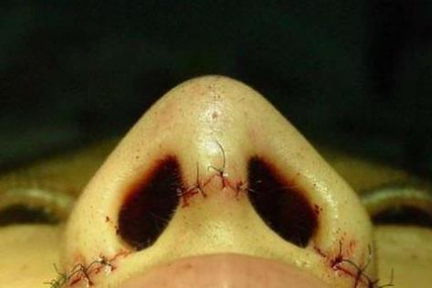 鼻翼縮小手術(shù)注意什么?