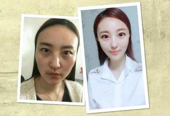 手術(shù)后兩個月