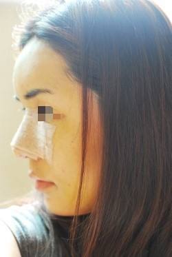 硅膠隆鼻術(shù)后