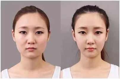 你打了注射瘦臉果不好？這些臉型這樣打注射瘦臉果才好！