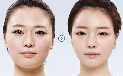 注射注射瘦臉原理