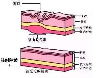 注射除皺使用玻尿酸和注射瘦臉原則上的區(qū)別！