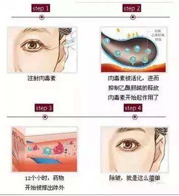 注射瘦臉持續(xù)的時(shí)間