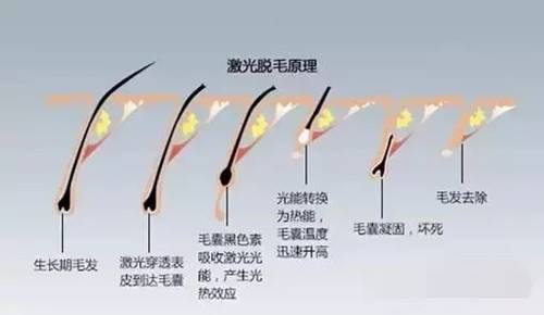 激光脫毛大概要多少錢？