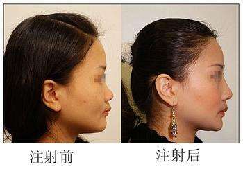 鄭州注射瑞藍(lán)玻尿酸多少錢？哪家醫(yī)院正規(guī)？