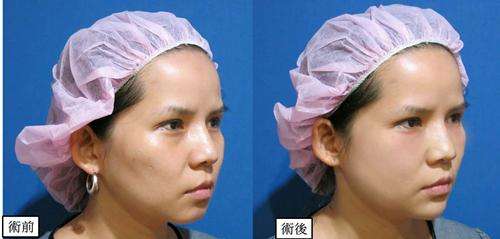 鄭州注射瑞藍(lán)玻尿酸多少錢？哪家醫(yī)院正規(guī)？