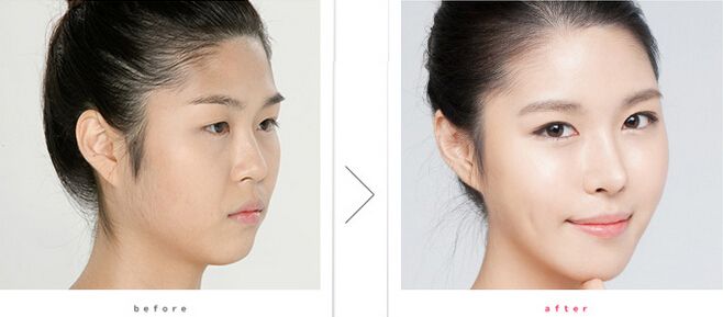 鼻頭鼻翼鼻尖整形恢復(fù)時(shí)期做好這幾招能恢復(fù)較快