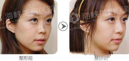 黃金三角鼻雕整形案例圖