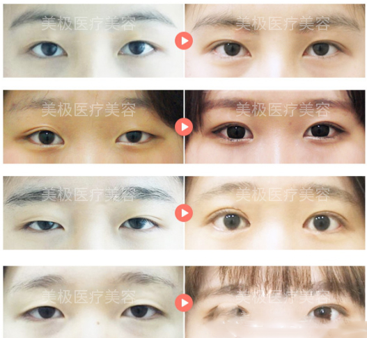 東莞美極醫(yī)療美容雙眼皮案例