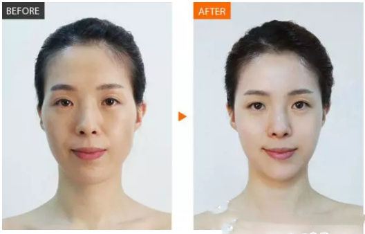 東莞美極醫(yī)療美容面部除皺案例對比圖