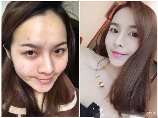 東莞美極醫(yī)療美容超激光美膚祛斑案例果圖