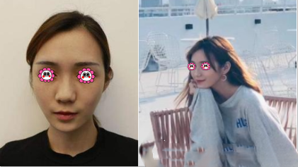 北京歐美隆鼻術(shù)案例