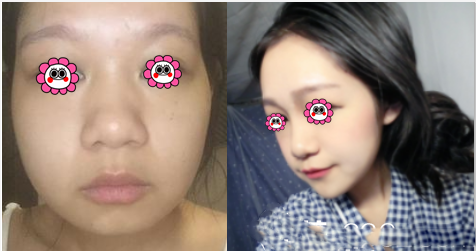 北京歐美瘦臉案例皺紋與瘦臉去除