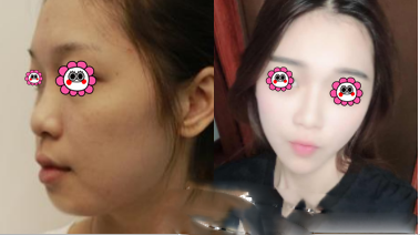 北京、歐美羊腸線嵌入推廣案例研究