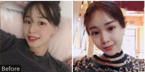 深圳、美國、加拿大陳群總裁雙眼皮切口案例圖