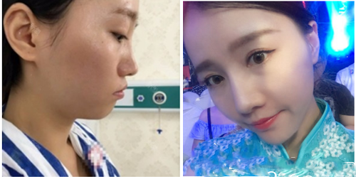 圖為深圳、美國、加拿大、周國偉隆鼻一例