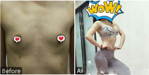 深圳、美國、加拿大、張志勇自體脂肪隆胸病例圖