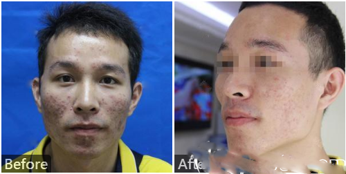 李莉點陣激光祛痘案例對比圖