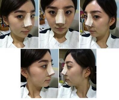 術(shù)后注意事項