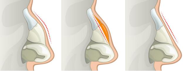 駝峰鼻手術(shù)