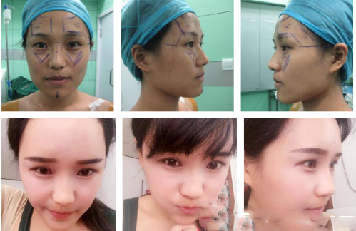 面部自體脂肪填充案例