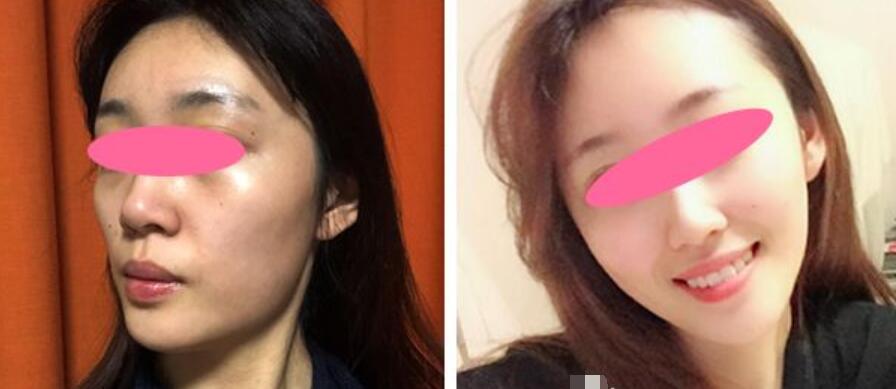 pst面部提升果的比較