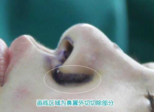 鼻翼縮小術(shù)的價(jià)錢大約多少？花費(fèi)詳細(xì)信息