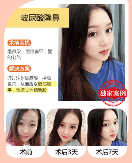 注射隆鼻果影響因素