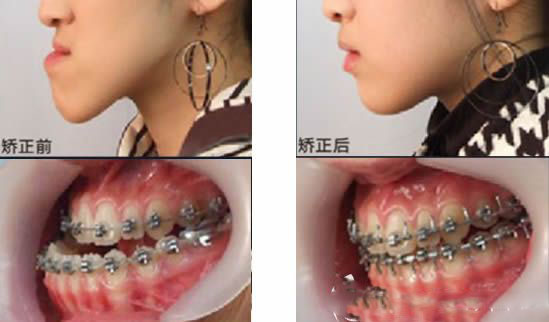 深圳世紀(jì)河山口腔高難度地包天矯正案例果