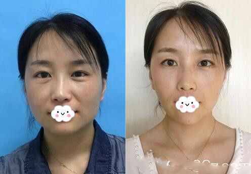 天津薇什醫(yī)療美容診所注射瘦臉抗皺注射瘦臉病例果圖
